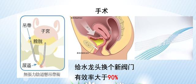咳嗽、大笑……滴滴答答的尷尬,關(guān)于尿失禁的那些事